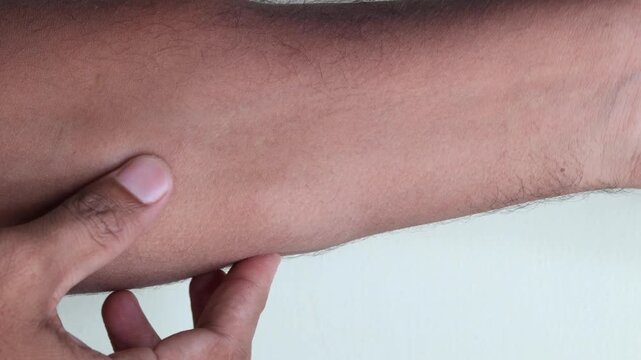Man with showing hand with multiple lipoma tumor, harmless and painelss tumor on the skin. Fatty tumor