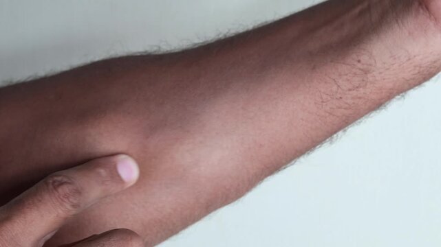 Man with showing hand with multiple lipoma tumor, harmless and painelss tumor on the skin. Fatty tumor
