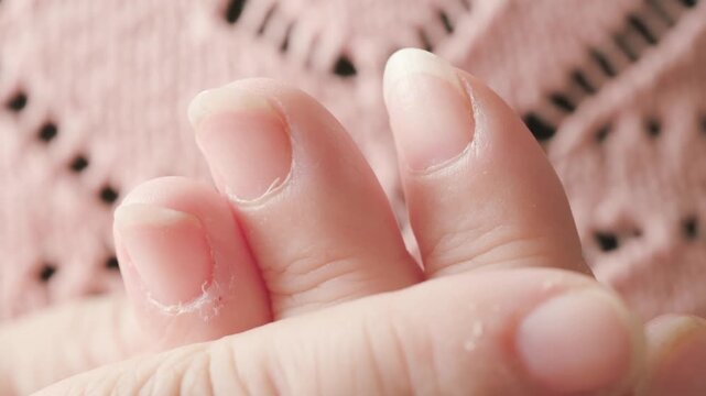 hangnails on fingers, skin scrap, area of ​​exfoliated epidermis surrounding nail, Compulsive nail and cuticle biting, Stress relief or self-harm, obsessive-compulsive disorder, mental health