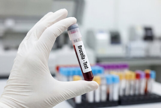 Gloved hand holding blood sample tube labeled brucella test in laboratory