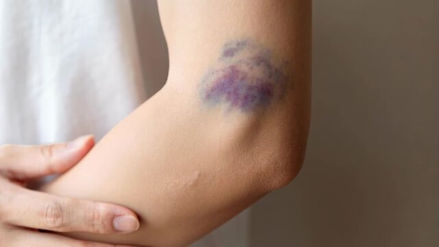 A woman gently touches a large hematoma on her arm, illustrating pain and physical injury.