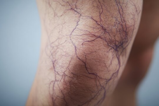Macro view of purple and blue spider veins visible on the skin of a human leg, representing vascular disease, telangiectasia, or blood circulation issues.