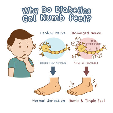 Diabetes nerve damage cause numbness in the toes, cartoon illustration on white background