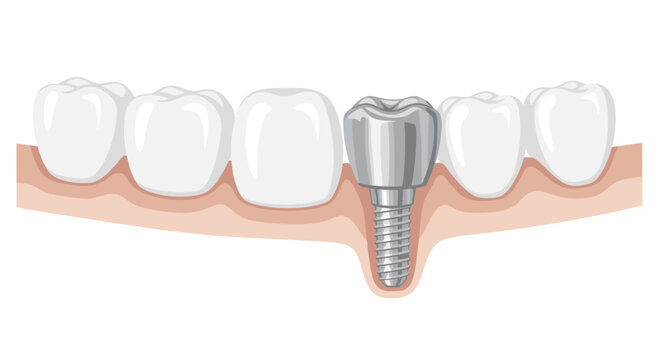 A professional dental restoration graphic displays a polished silver metallic crown and implant post situated between natural white molars in tan gum tissue.
