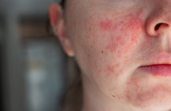 Close-up of a young womans face with visible skin irritation and redness. Inflamed, dry, and textured skin. Concept of sensitive skin, allergy, inflammation, and skincare problems