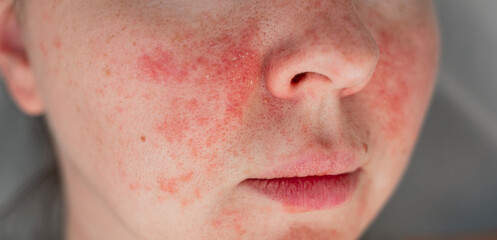 Close-up of a young womans face with visible skin irritation and redness. Inflamed, dry, and...