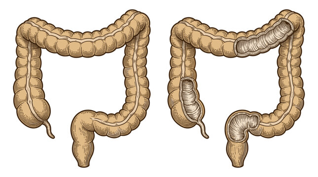 Anatomical illustration comparing a healthy colon with a diseased colon showing diverticula and inflammation.