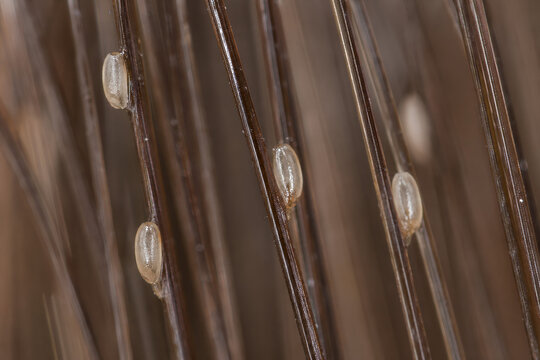 Extreme macro of head lice eggs (nits) attached to brown human hair strands, dermatology infestation detail with selective focus and high resolution lighting