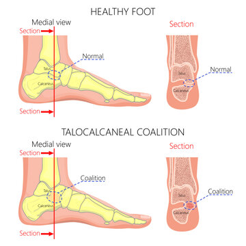 Normal foot and a foot with talocalcaneal coalition