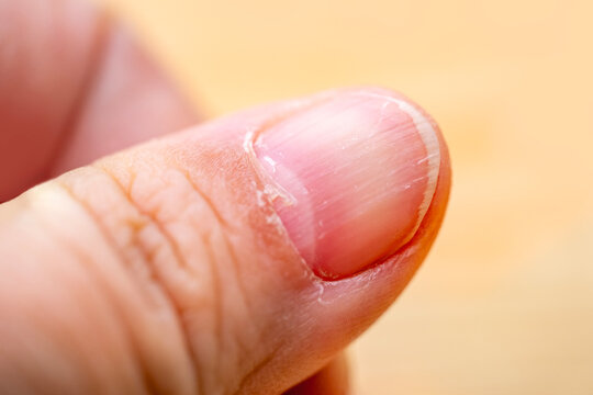 Macro shot of woman finger with hangnail and dry cuticle, Close up of female finger with hangnail, dry skin around nail, manicure problem, personal care, hygiene and skin condition concept
