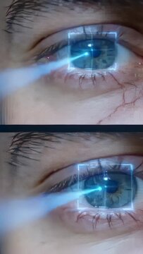 Vertical video: Fading overlay signaling probe entering cornea at clinic, bright dot scanning pupil