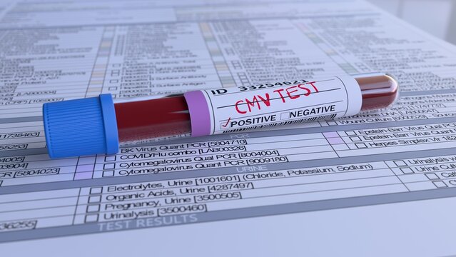 CMV Test Positive Blood Test Result
