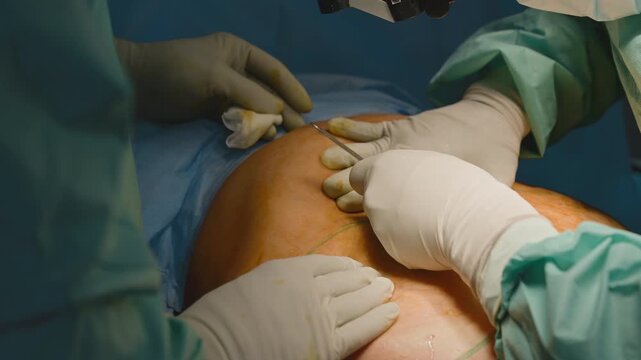 Close up males hands in protective gloves doing surgery operation. Two unrecognizable men doctors surgeons cutting skin with scalpel cut patient abdomen medication emergency medicine cancer disease