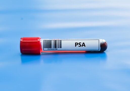 Blood sample tube for prostate specific antigen (PSA) test analysis.