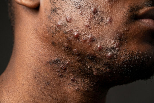 Severe inflammatory acne and folliculitis on Black man face