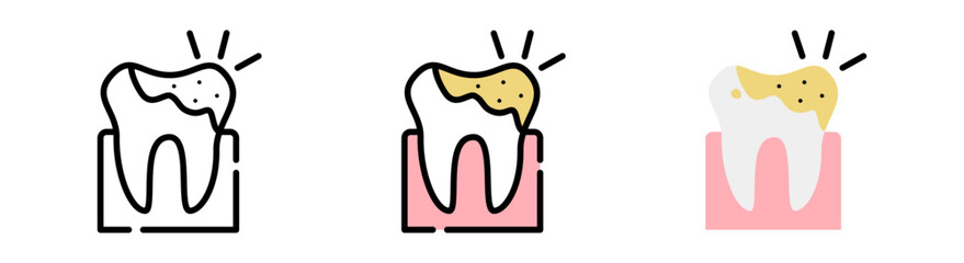 Obraz premium Dental caries (tooth decay) and plaque buildup. 