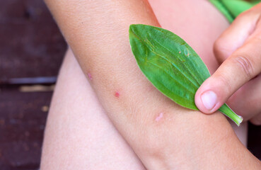 Child applies plantain leaf to wound. Children injuries in summer outdoors. Phytotherapy, folk medicine © Elena