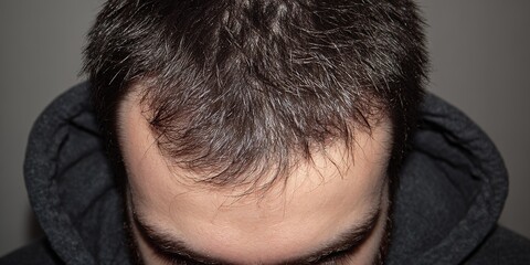 Fototapeta premium Close-up of a mans head, focusing on his hairline.