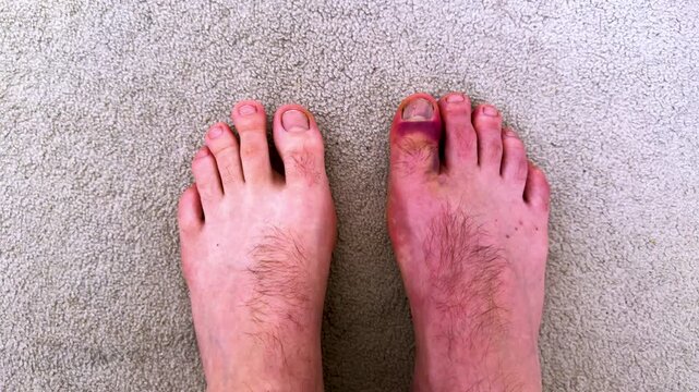 Close-up view of a male foot with visible bruising on the right toe, contrasting with the left foot, on a light carpet background, highlighting injury progression