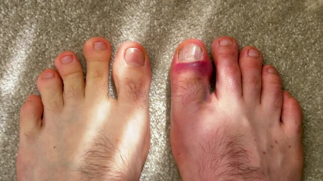 Close-up view of two human feet on a light carpet, one foot with a bruised big toe and the other foot showing healthy toes, highlighting visible injury progression