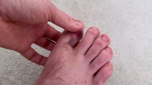 Male hand examines bruised toe on foot, applying pressure to the injured area while seated on a light-colored carpet in a well-lit indoor setting