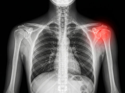 Xray image of a human skeleton with a highlighted shoulder injury on the left side showing bones and joints in detail