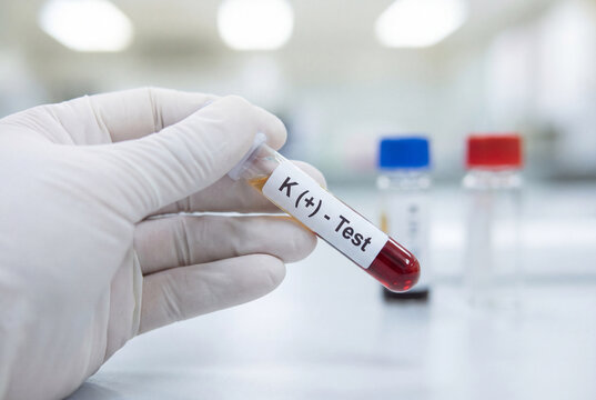 Gloved hand holding a blood sample tube for a potassium test in a medical lab