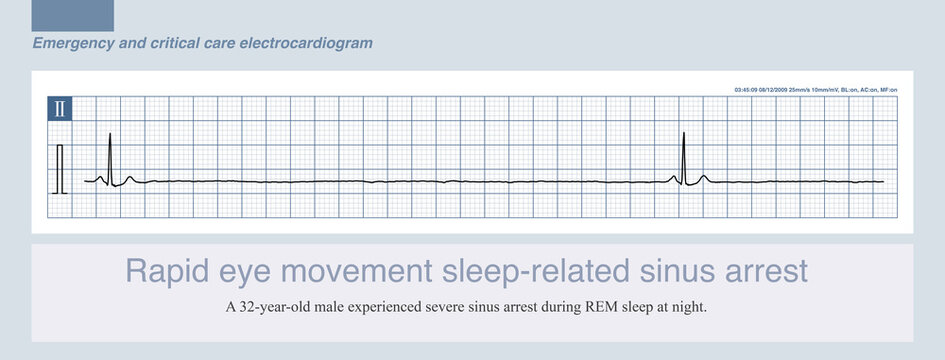 During sleep, especially rapid eye movement (NREM) sleep, vagal tone increases, making various bradycardias, such as sinus pauses, more likely to occur.
