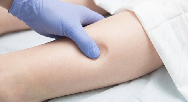 Doctor performing pitting edema test on patient's leg