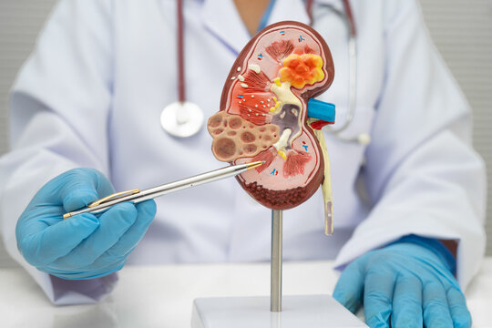 Chronic kidney disease, doctor with model for treatment urinary system, urology, Estimated glomerular filtration rate eGFR.