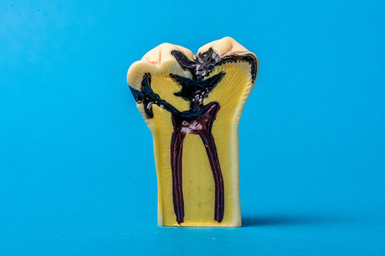 Tooth cross section showing severe decay and dental pulpitis