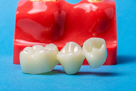 Dental bridge on a model demonstrating tooth restoration