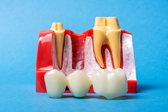 Dental bridge and implant models for restorative dentistry