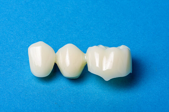 Dental bridge crowns for tooth replacement and oral health