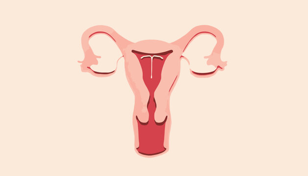 Illustration of the female reproductive system with an intrauterine device (IUD) inserted for contraception