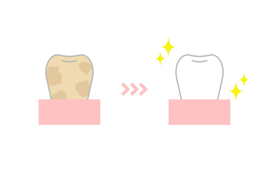 汚い歯がホワイトニングで清潔できれいな歯になるイメージイラスト