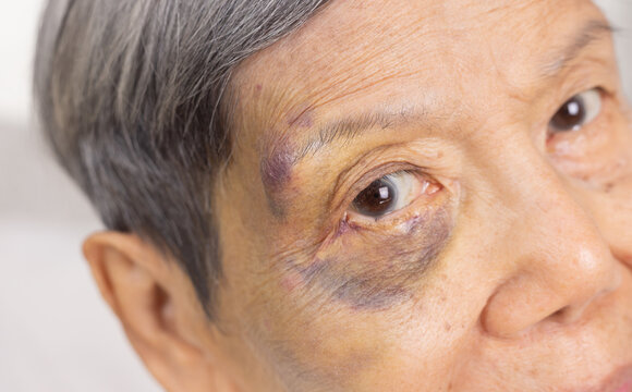 Elderly woman Have A Bruise on Face After Falling in Bedroom.