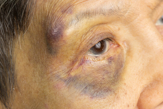 Elderly woman Have A Bruise on Face After Falling in Bedroom.