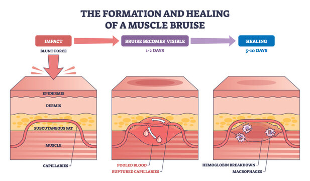 Muscle bruise formation and healing shown stepwise, from impact to repair via pooled blood, ruptured capillaries, and macrophages. Outline diagram