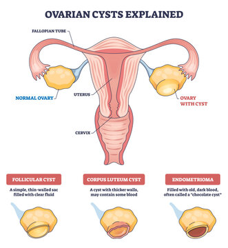 Ovarian cysts explained, simplified reproductive anatomy comparing uterus, normal ovary, and ovary with cyst to show types and causes for patients and students. Outline diagram