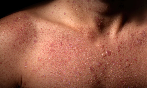 Close-up View of Inflamed Human Skin With Visible Folliculitis Representing Challenging Dermatological Conditions and Pathology