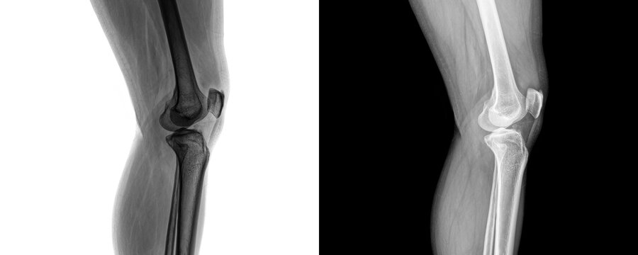 Diagnostic Knee Joint X-ray Lateral View Showing Femur, Tibia, and Patella Alignment for Evaluation of Arthritis Pain Isolated on Transparent Background