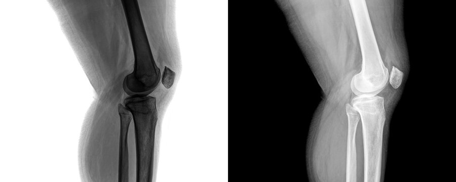 Clinical Knee Joint Lateral Radiograph Showing Bone Structure and Degenerative Changes for Arthritis Diagnosis Isolated on Transparent Background