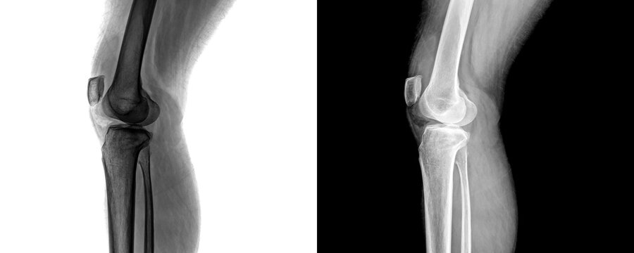 Diagnostic Knee Joint Lateral Radiograph Showing Femur, Tibia, Patella Alignment for Arthritis Detection Isolated on Transparent Background
