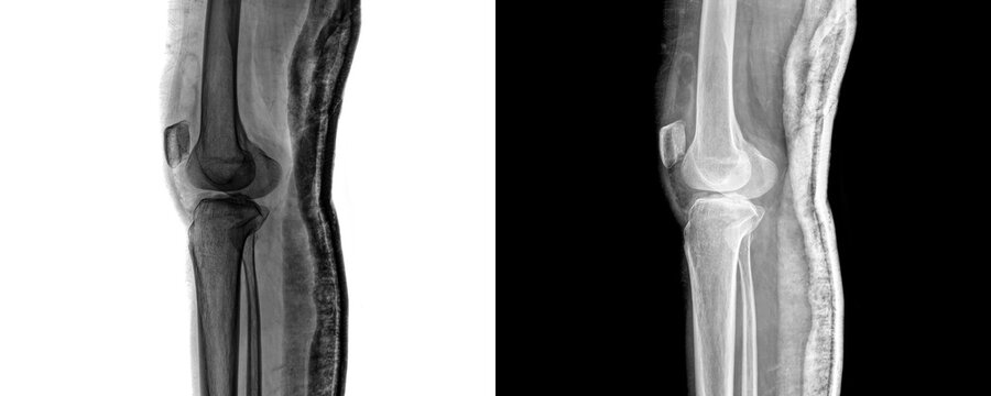 Knee Joint Lateral View X-ray Image Showing Bone Structure and Joint Space for Arthritis Diagnosis Isolated on Transparent Background