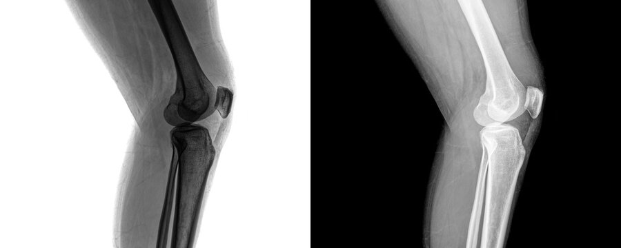 Clinical Knee Joint Lateral Projection X-ray Showing Bone Structure for Arthritis Assessment Isolated on Transparent Background