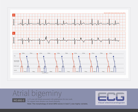 A sinus beat and an atrial premature beat alternate. The QRS complex of premature atrial contractions is accompanied by varying degrees of iintraventricular aberrant conduction.

