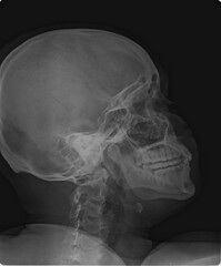 Professional lateral X-ray of a human skull showing the cranium, facial bone structure, and upper cervical vertebrae. © RadVisuals