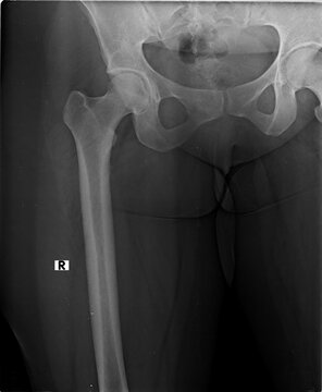 Clear digital scan of an adult hip and femur captured via digital radiography for clinical evaluation of the joint space.