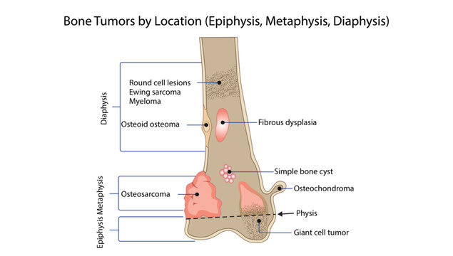Bone Tumors by Location (Epiphysis, Metaphysis, Diaphysis)
bone tumors according to their typical location within long bones.